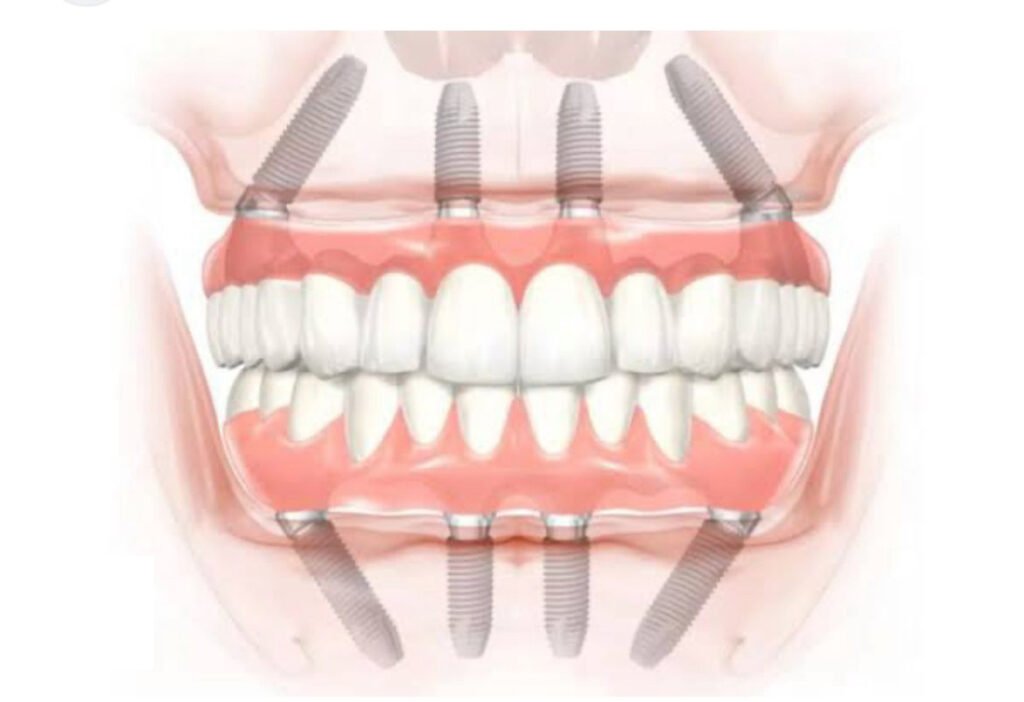 Especialista em Implante Dentário 1 implante2