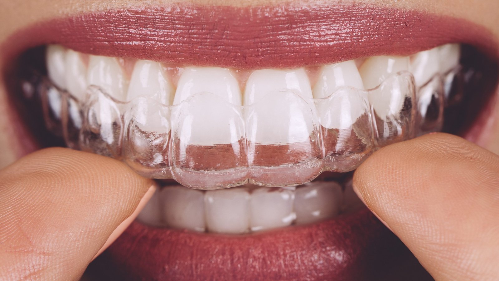 Início 4 Guia Completo do Invisalign: o que é, como funciona e vantagens