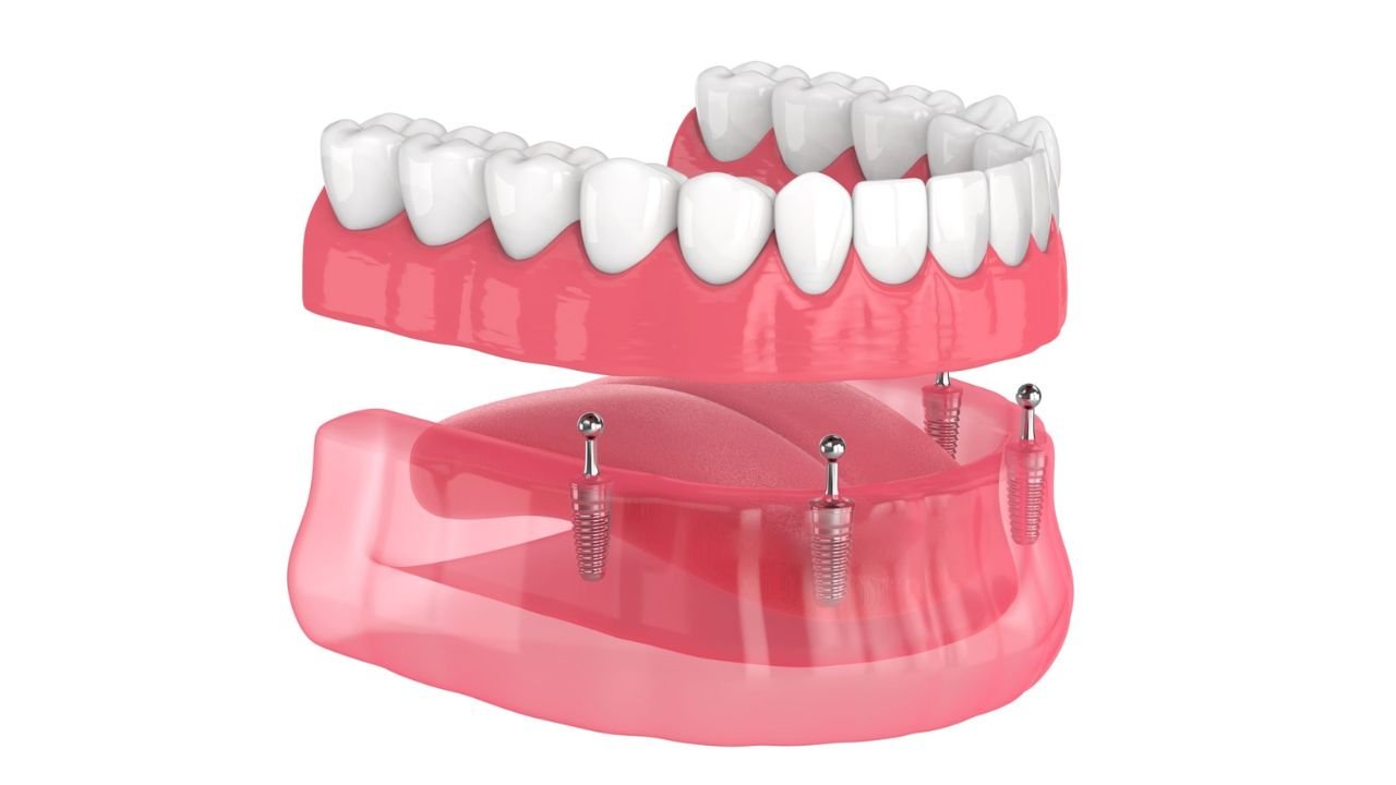 Início 5 Dentadura Fixa: o que é, como funciona e onde encontrar especialistas: Guia Completo